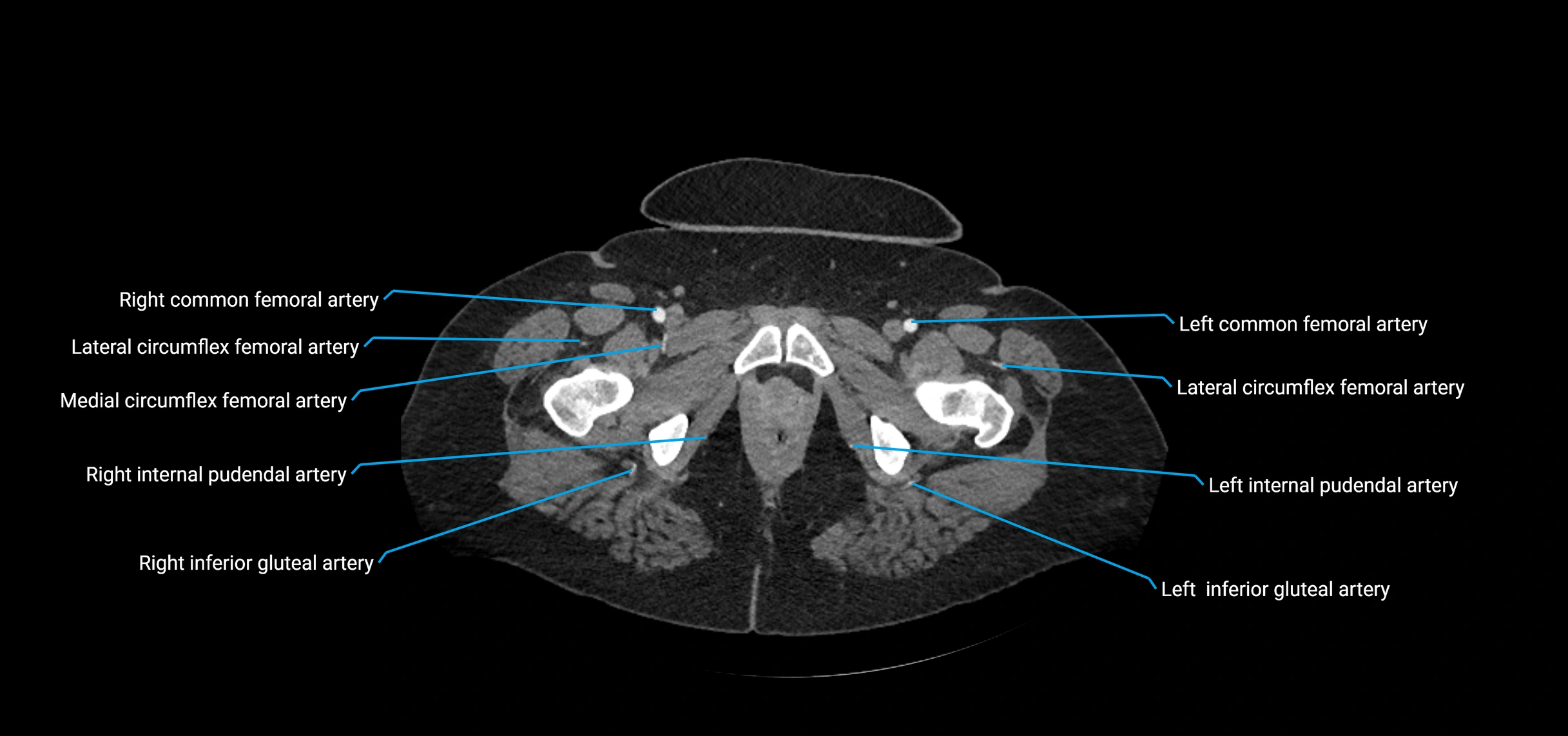 CTA abdomen axial cross sectional anatomy labelled image_265 (2).webp